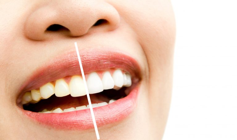 Top 5 Benefits of Professional Teeth Whitening