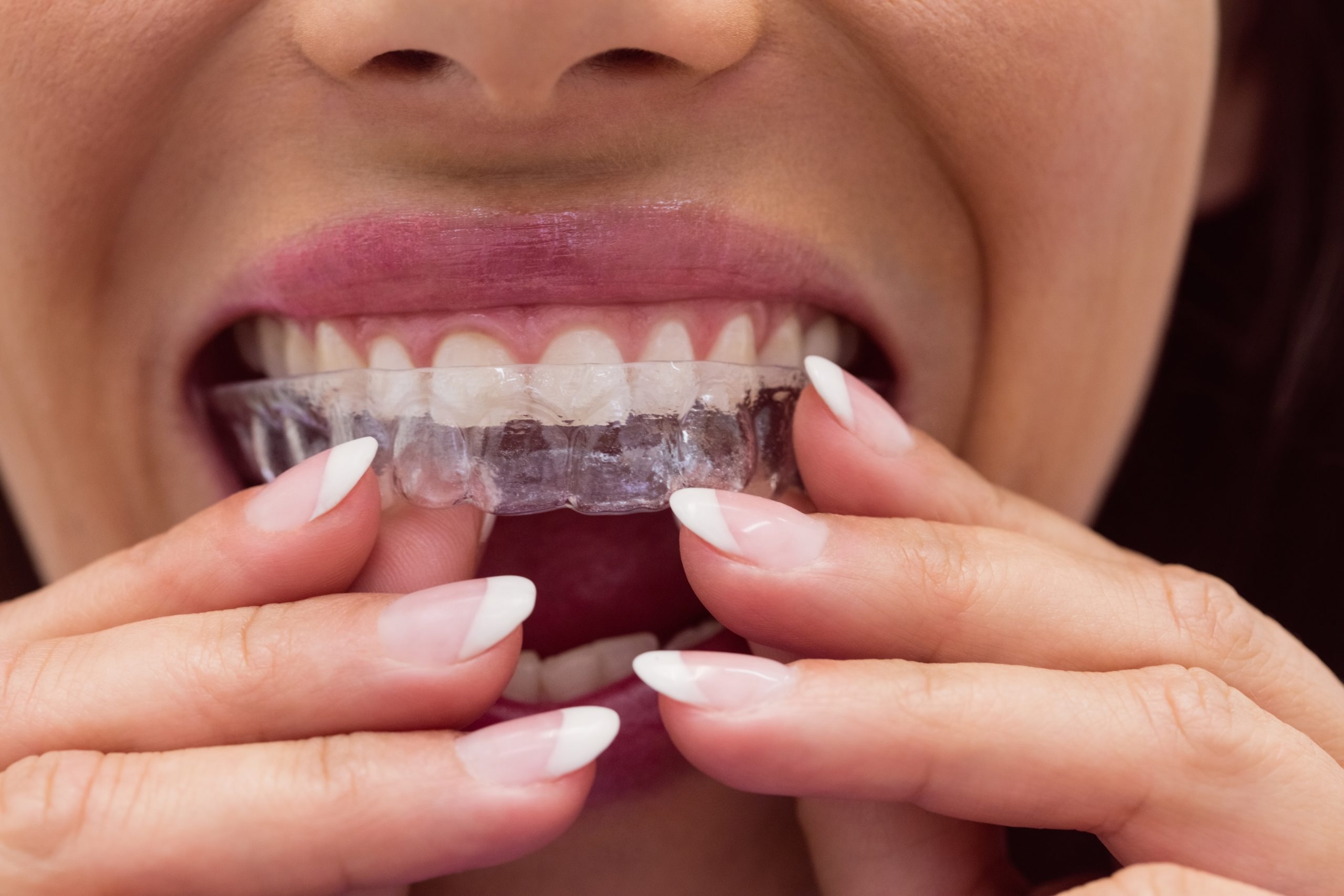 Invisalign® Treatment
